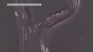 Pasożyt w ludzkim oku