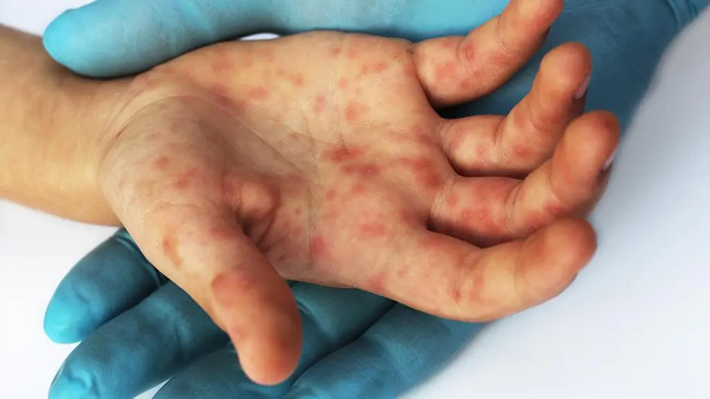 Dr Paweł Grzesiowski o epidemii odry