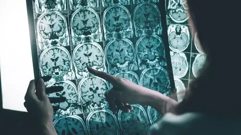 Choroba Alzheimera zobrazowana metodą rezonansu magnetycznego (MRI)