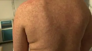 Przybywa zakażonych odrą na Podkarpaciu. Kolejne osoby czekają na wynik