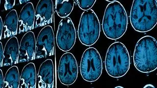 "Jaka witamina najlepiej chroni nasze starzejące się mózgi?"