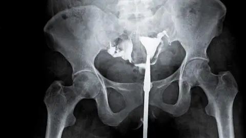 Naukowcy: trwająca przez całe życie nadwaga zwiększa ryzyko raka endometrium prawie dwukrotnie