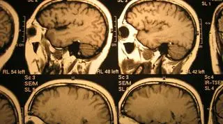 Naukowcy z Kliniki Mayo przeanalizowali 3,5 tys. mózgów by ustalić co powoduje Alzheimera 