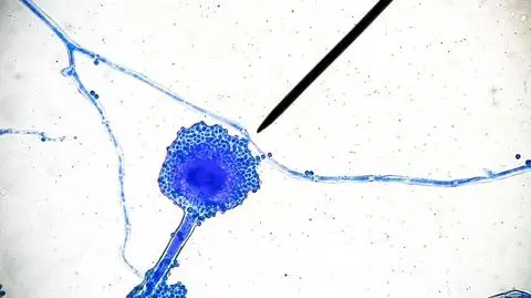 Coraz więcej przypadków zachorowań. Śmiercionośny "czarny grzyb" atakuje chorych na COVID-19