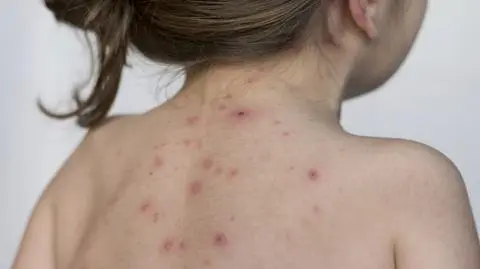 Odra jest wirusową chorobą zakaźną