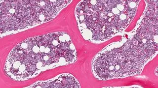 Komórki macierzyste pomogą zwalczyć guza mózgu?