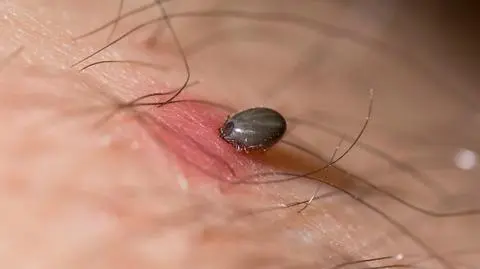 Na boreliozę nie ma szczepionki, jedna jest w fazie klinicznej. "Zaszczepieni wytworzyli znaczną ilość przeciwciał"