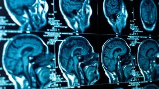 Przekrój mózgu na obrazie tomografii komputerowej