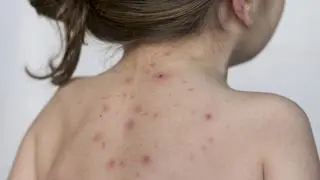 Odra jest wirusową chorobą zakaźną