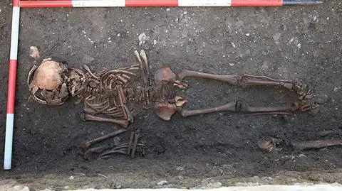 Naukowcy zidentyfikowali kilka przypadków wrodzonej kiły