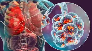 Wizualizacja bakterii Klebsiella pneumoniae w płucach