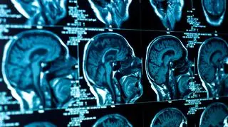 Tłuste potrawy sprzyjają degeneracji połączeń między neuronami