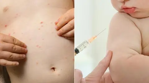 Dwa ogniska odry pod Warszawą