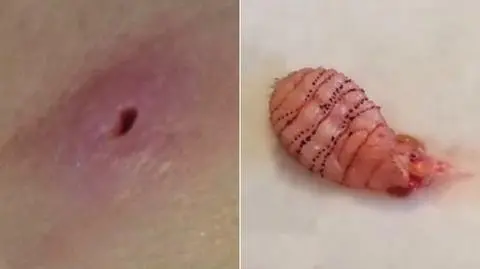 Larwa muchy w środku skóry