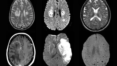 Neurologiczne powikłania po COVID-19. "Okaże się, czy będziemy świadkami epidemii uszkodzeń mózgu"