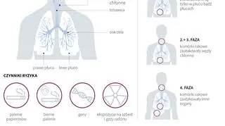 Rak płuca (Maria Samczuk/PAP)