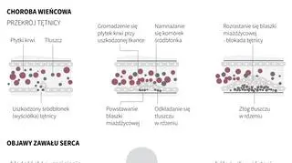 Zawał serca (Maria Samczuk, Adam Ziemienowicz/PAP)