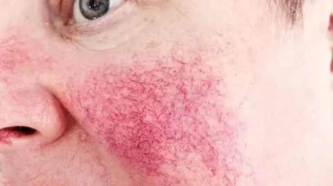 Trądzik różowaty jest chorobą, którą należy konsultować z dermatologiem 