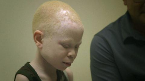 Albinosi ofiarami przesądów 