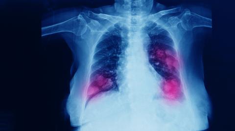 "Jak każdej zimy tak również teraz stężenie smogu w powietrzu rośnie"