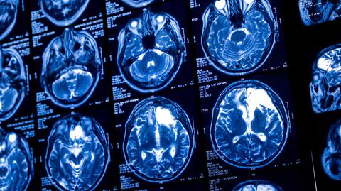 Choroba Alzheimera. Uniwersytet w Białymstoku zakupił specjalne urządzenie do diagnostyki