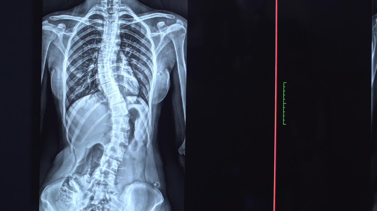 Innowacyjna metoda leczenia skoliozy. Mało pacjentów wie, iż jest dostępna w Polsce