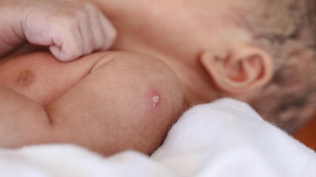 Główny Inspektor Sanitarny uspokaja: "Szczepienie dziecka z SCID-em to nie wyrok"