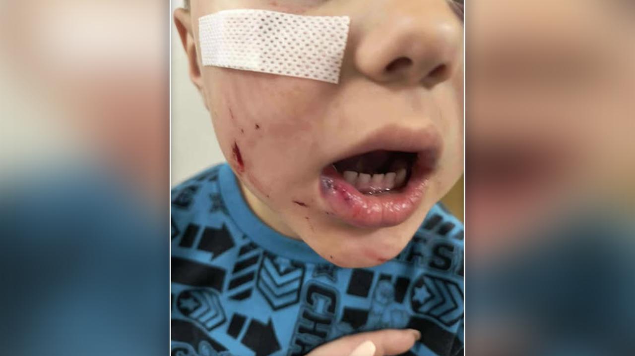 Buldog ugryzł Frania w twarz, właściciela czworonoga zatrzymano po sześciu dniach