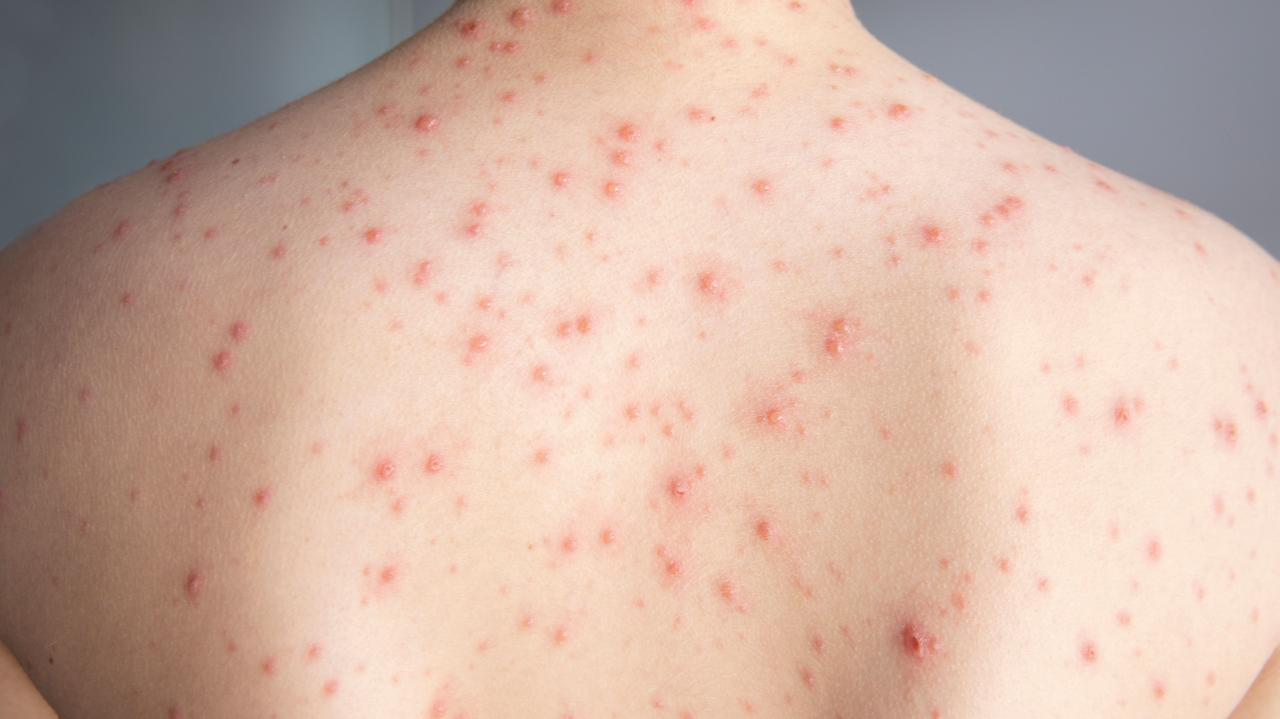 Rośnie liczba zakażeń ospą wietrzną w Polsce. "To wrota infekcji"