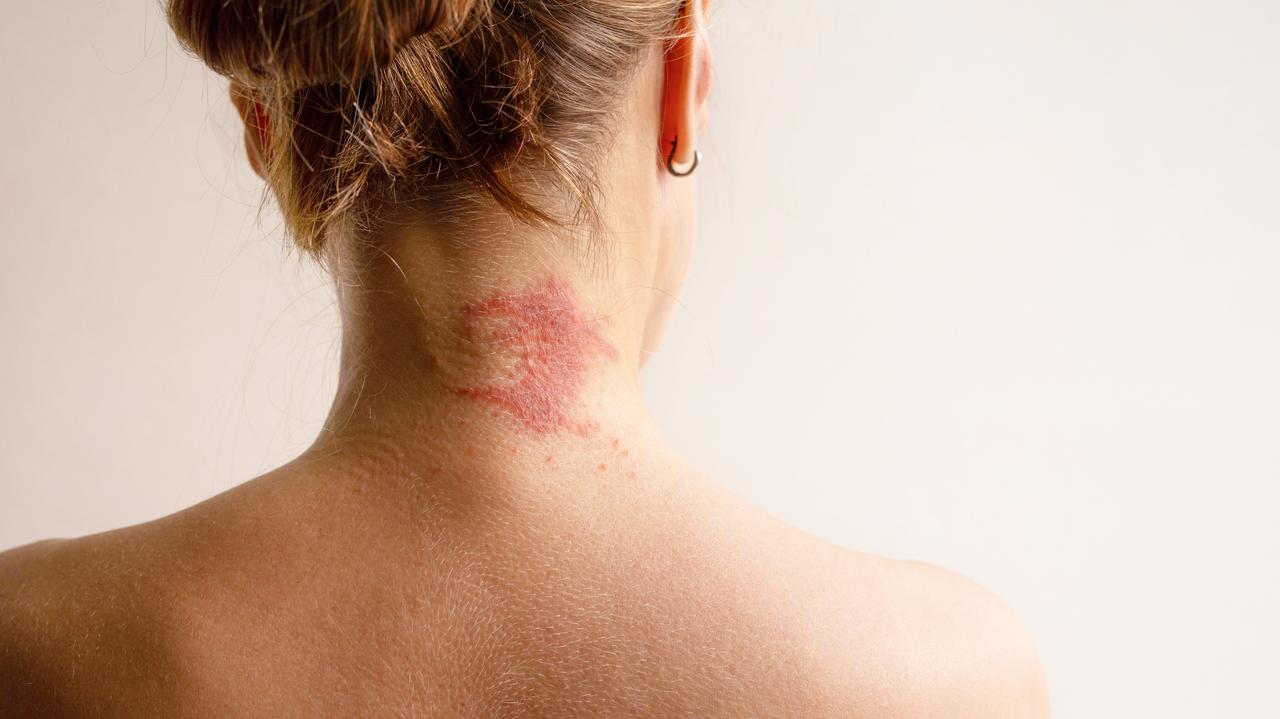 Zaczyna się od plamy na skórze. Może skończyć się chorobą, która zabija