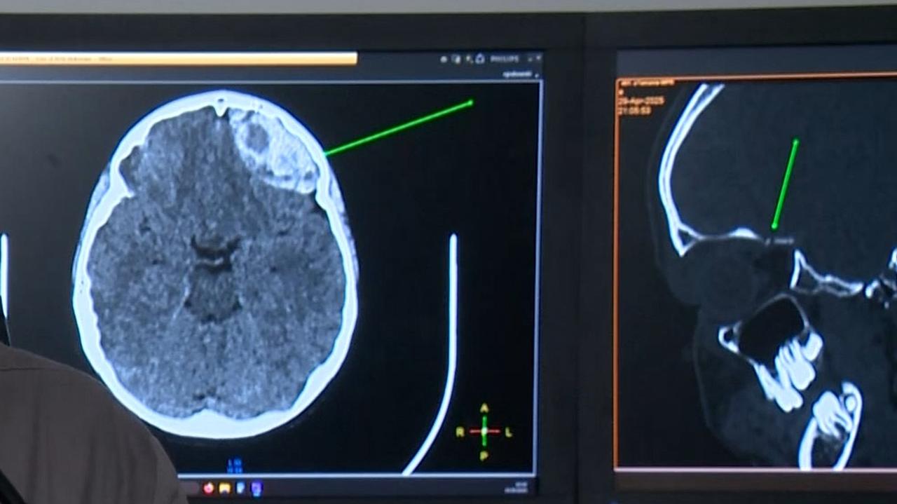Tak wygląda mózg po wypadku na hulajnodze