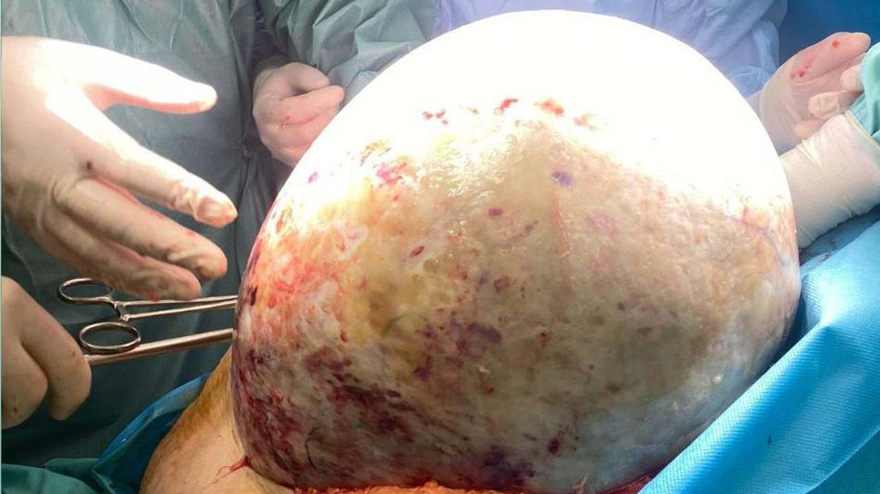 Gigantyczny guz jajnika został wycięty w elbląskim szpitalu. Operacja była wyjątkowo trudna