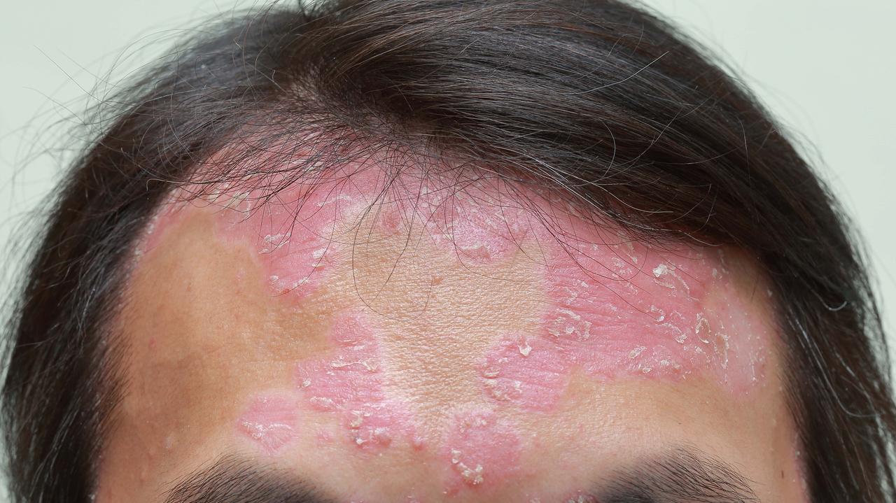 Tej zakaźnej choroby nie było w Europie od dekad. Zakażenia w salonie masażu