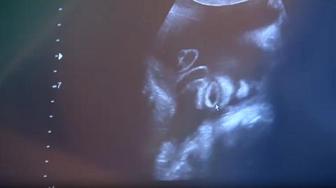 Koalicja Obywatelska i Lewica chcą zmian w prawie aborcyjnym