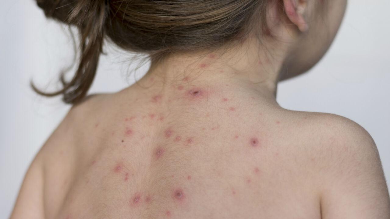 Kolejne przypadki odry w tym regionie. Liczba zakażonych wzrosła prawie dwukrotnie