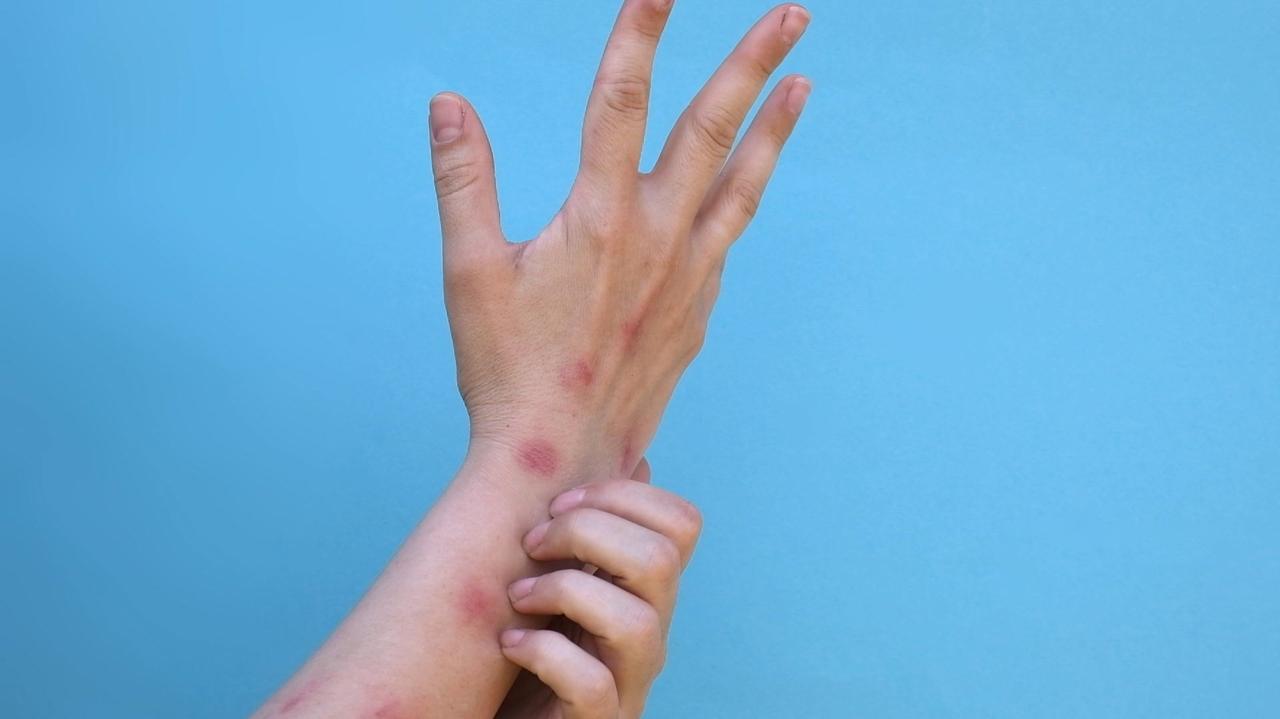 Małpia ospa w Europie. Jak można się nią zarazić?