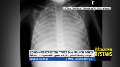 Łódź: Chłopiec przez Covid-19 miał zajęte 99 procent płuc. Lekarzom udało się go uratować