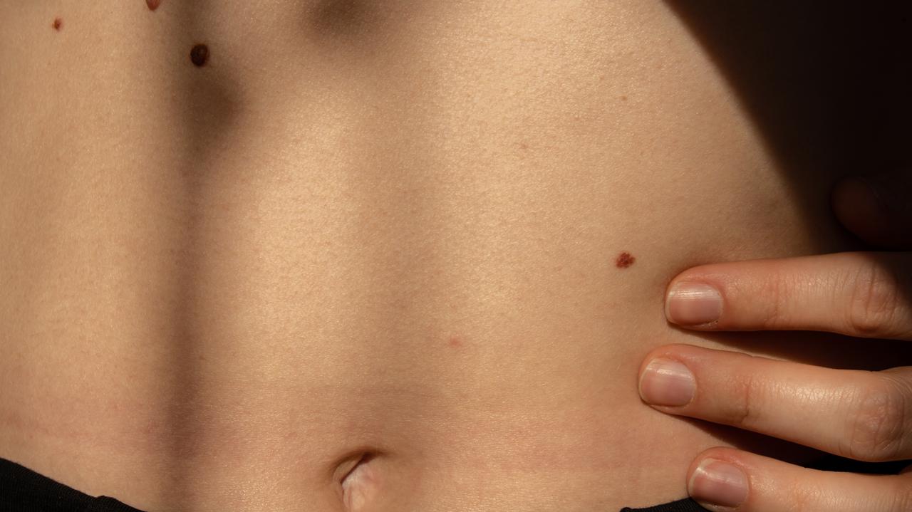 Onkolog ostrzega: nawet SPF 50 nie chroni w pełni przed słońcem i ryzykiem czerniaka