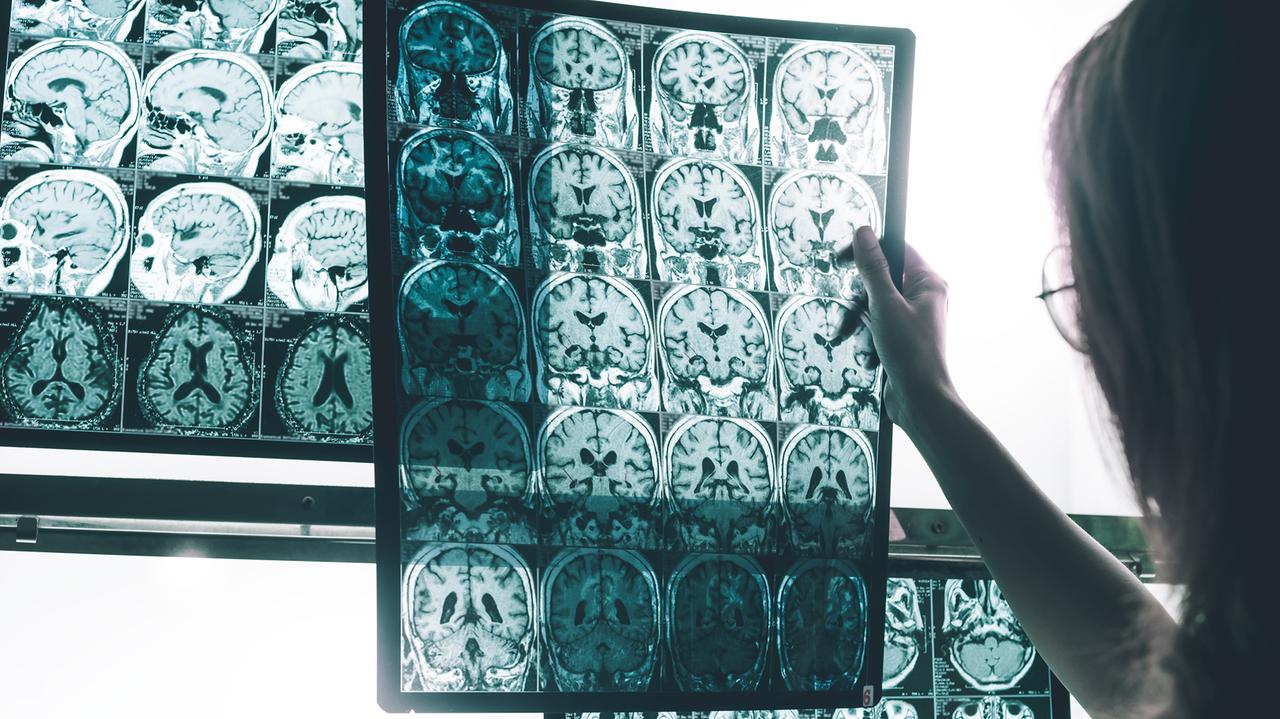 Nowa terapia dla chorych na Alzheimera. Wkrótce badania w Polsce