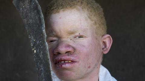 Zabójstwa i porwania albinosów w Afryce