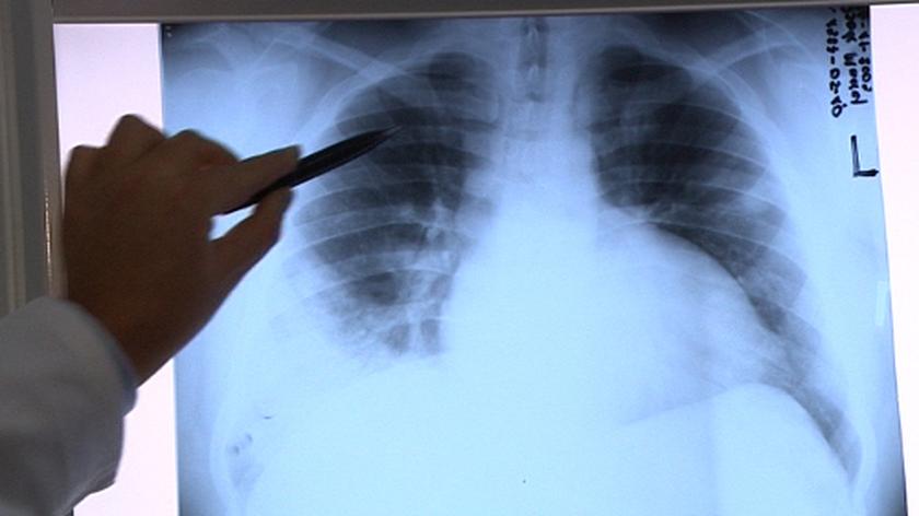 Zapalenie płuc jest niezwykle groźne (TVN24)