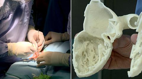 Wydrukowany w 3D model  alternatywą dla operacji na otwartym sercu