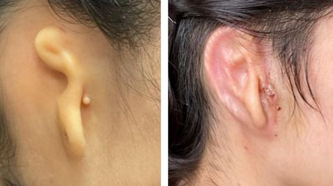 Implant ucha wykonany technologi biodruku 3D