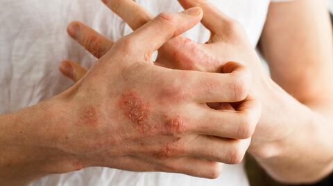 Alergie pokarmowe mogą dawać różne objawy
