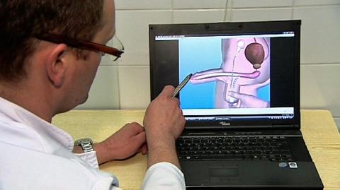 Przełom w leczeniu zaburzeń wzwodu. Polscy lekarze po raz pierwszy wszczepili implant prącia (TVN24)