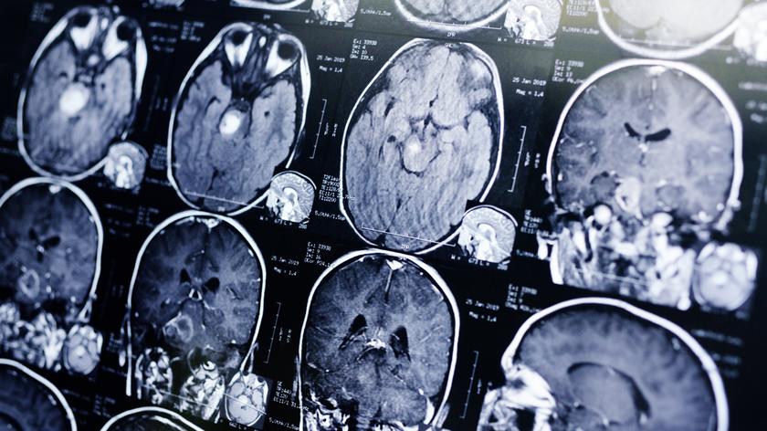 Tajemnicze zaburzenia mózgu w kanadyjskiej prowincji Nowy Brunszwik